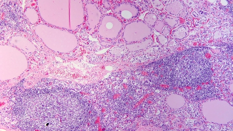 Histopathology of Hashimoto's thyroiditis Hashimoto's thyroiditis with lymphoid infiltration. Autoantibodies against thyroid peroxidase and thyroglobulin were elevated.
https://upload.wikimedia.org/wikipedia/commons/d/de/Hashimoto%27s_thyroiditis%2C_HE_4.jpg